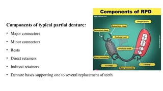Comprehensive Overview of Major Connectors in Partial Dentures: Design ...