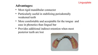 Comprehensive Overview of Major Connectors in Partial Dentures: Design ...