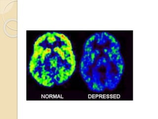 Major depressive disorder