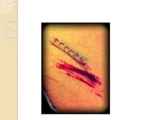 Major depressive disorder