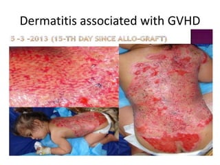 Dermatitis associated with GVHD
 