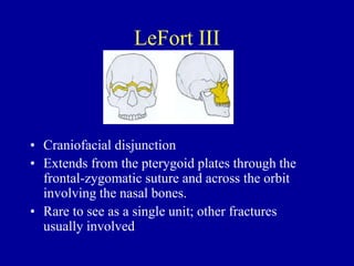 LeFort III
• Craniofacial disjunction
• Extends from the pterygoid plates through the
frontal-zygomatic suture and across the orbit
involving the nasal bones.
• Rare to see as a single unit; other fractures
usually involved
 