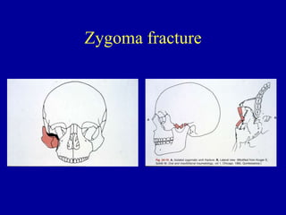 Zygoma fracture
 
