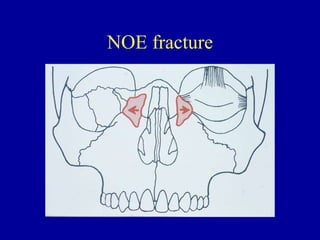 NOE fracture
 