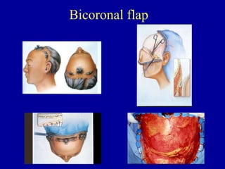 Bicoronal flap
 