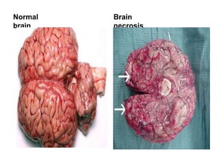 Normal
brain
Brain
necrosis
 