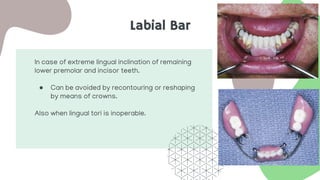 Labial Bar
In case of extreme lingual inclination of remaining
lower premolar and incisor teeth.
● Can be avoided by recontouring or reshaping
by means of crowns.
Also when lingual tori is inoperable.
 