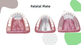 Palatal Plate
 