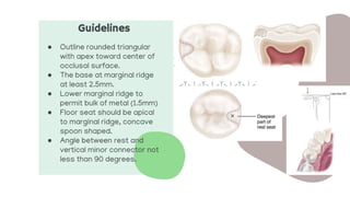 Guidelines
● Outline rounded triangular
with apex toward center of
occlusal surface.
● The base at marginal ridge
at least 2.5mm.
● Lower marginal ridge to
permit bulk of metal (1.5mm)
● Floor seat should be apical
to marginal ridge, concave
spoon shaped.
● Angle between rest and
vertical minor connector not
less than 90 degrees.
 