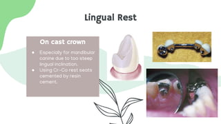 Lingual Rest
● Especially for mandibular
canine due to too steep
lingual inclination.
● Using Cr-Co rest seats
cemented by resin
cement.
On cast crown
 