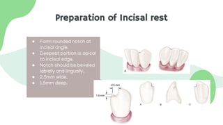Preparation of Incisal rest
● Form rounded notch at
incisal angle.
● Deepest portion is apical
to incisal edge.
● Notch should be beveled
labially and lingually.
● 2.5mm wide.
● 1.5mm deep.
 