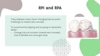RPI and RPA
They address class I lever changing fulcrum point.
It belongs to mesial rest concept.
To avoid harmful tipping and torquing on abutment
either:
- Change fulcrum location (mesial rest concept)
- Use of flexible arm (wrought wire)
 