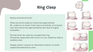 Ring Clasp
Nearly encircle all tooth.
When proximal undercut cannot be approached.
ML undercut on lower molar due to proximity of occlusal
rest and cannot be approached by bar due to lingual
inclination.
Should never be used as unsupported ring.
Should be supported with struct on non-retentive side or
auxiliary rest.
Maybe used in reverse on abutment anterior to tooth
supported edentulous area.
 