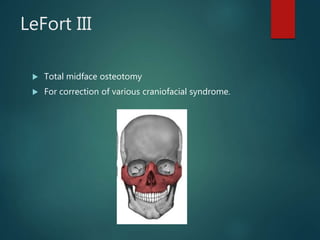 LeFort III
 Total midface osteotomy
 For correction of various craniofacial syndrome.
 