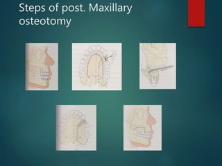 Steps of post. Maxillary
osteotomy
 