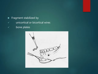  Fragment stabilized by
 unicortical or bicortical wires
 bone plates
 