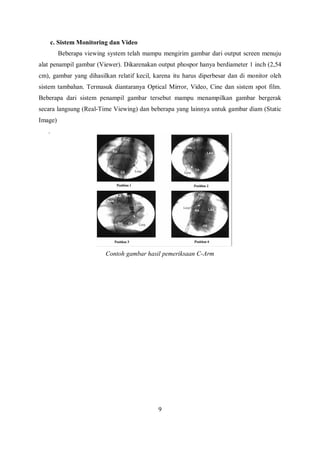 c. Sistem Monitoring dan Video
Beberapa viewing system telah mampu mengirim gambar dari output screen menuju
alat penampil gambar (Viewer). Dikarenakan output phospor hanya berdiameter 1 inch (2,54
cm), gambar yang dihasilkan relatif kecil, karena itu harus diperbesar dan di monitor oleh
sistem tambahan. Termasuk diantaranya Optical Mirror, Video, Cine dan sistem spot film.
Beberapa dari sistem penampil gambar tersebut mampu menampilkan gambar bergerak
secara langsung (Real-Time Viewing) dan beberapa yang lainnya untuk gambar diam (Static
Image)
.
Contoh gambar hasil pemeriksaan C-Arm
9
 