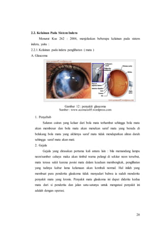 28
2.2. Kelainan Pada Sistem Indera
Menurut Kus 262 : 2004, menjelaskan beberapa kelainan pada sistem
indera, yaitu :
2.2.1.Kelainan pada indera penglihatan ( mata )
A. Glaucoma
Gambar 12 : penyakit glaucoma
Sumber : www.acemaxs05.wordpress.com
1. Penyebab
Saluran cairan yang keluar dari bola mata terhambat sehingga bola mata
akan membesar dan bola mata akan menekan saraf mata yang berada di
belakang bola mata yang akhirnya saraf mata tidak mendapatkan aliran darah
sehingga saraf mata akan mati.
2. Gejala
Gejala yang dirasakan pertama kali antara lain : bila memandang lampu
neon/sumber cahaya maka akan timbul warna pelangi di sekitar neon tersebut,
mata terasa sakit karena posisi mata dalam keadaan membengkak, penglihatan
yang tadinya kabur lama kelamaan akan kembali normal. Hal inilah yang
membuat para penderita glaukoma tidak menyadari bahwa ia sudah menderita
penyakit mata yang kronis. Penyakit mata glaukoma ini dapat diderita kedua
mata dari si penderita dan jalan satu-satunya untuk mengatasi penyakit ini
adalah dengan operasi.
 
