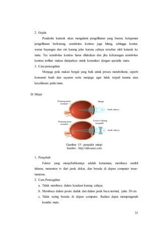 31
2. Gejala
Penderita katarak akan mengalami pengelihatan yang buram, ketajaman
pengelihatan berkurang, sensitivitas kontras juga hilang, sehingga kontur,
warna bayangan dan visi kurang jelas karena cahaya tersebar oleh katarak ke
mata. Tes sensitivitas kontras harus dilakukan dan jika kekurangan sensitivitas
kontras terlihat makan dianjurkan untuk konsultasi dengan spesialis mata.
3. Cara pencegahan
Menjaga pola makan bergizi yang baik untuk proses metabolisme, seperti
konsumsi buah dan sayuran serta menjaga agar tidak terjadi trauma atau
kecelakaan pada mata.
D. Miopi
Gambar 15 : penyakit miopi
Sumber : http://ridwanaz.com
1. Penyebab
Faktor yang menyebabkannya adalah keturunan, membaca sambil
tiduran, menonton tv dari jarak dekat, dan berada di depan computer terus-
menerus.
2. Cara Pencegahan
a. Tidak membaca dalam keadaan kurang cahaya.
b. Membaca dalam posisi duduk dan dalam jarak baca normal, yaitu 30 cm.
c. Tidak sering berada di depan computer. Radiasi dapat mempengaruhi
kondisi mata.
 