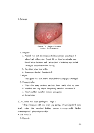 36
B. Sariawan
Gambar 20 : penyakit sariawan
Sumber : health.detik.com
1. Penyebab
a. Penyakit pada lidah ini merupakan ketidak normalan yang terjadi di
selaput lendir dalam mulut. Bentuk fisiknya ialah luka di mulut yang
disertai bercak berwarna putih. Bercak putih ini terkadang agak sedikit
kekuningan dan akan berbentuk cekung.
b. Daya tahan tubuh yang tendah
c. Kekurangan vitamin c dan vitamin b
2. Gejala
Terasa perih pada lidah, timbul bercak merah kadang agak kekuningan.
3. Cara pencegahan
a. Tidak terlalu sering meminum air dingin disaat kondisi tubuh lagi panas
b. Memakan buah yang banyak mengandung vitamin c dan vitamin b.
c. Tidak berlebihan memakan makanan yang pedas.
d. Kurangi stress
2.2.4.Kelainan pada Indera pendengar ( Telinga )
Telinga merupakan salah satu organ yang penting. Sebagai organtubuh yang
lemah, telinga bisa mengalami kelainan maupun terserangpenyakit. Berikut
beberapa penyakit yang ada pada telinga:
A. Tuli Konduktif
1. Penyebab
 