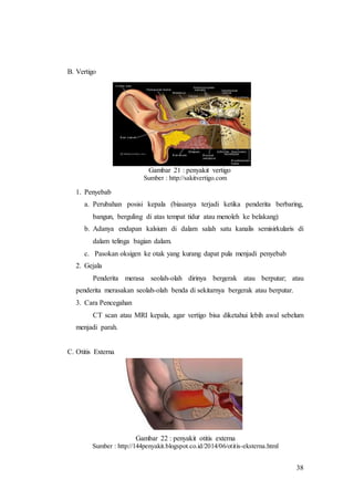 38
B. Vertigo
Gambar 21 : penyakit vertigo
Sumber : http://sakitvertigo.com
1. Penyebab
a. Perubahan posisi kepala (biasanya terjadi ketika penderita berbaring,
bangun, berguling di atas tempat tidur atau menoleh ke belakang)
b. Adanya endapan kalsium di dalam salah satu kanalis semisirkularis di
dalam telinga bagian dalam.
c. Pasokan oksigen ke otak yang kurang dapat pula menjadi penyebab
2. Gejala
Penderita merasa seolah-olah dirinya bergerak atau berputar; atau
penderita merasakan seolah-olah benda di sekitarnya bergerak atau berputar.
3. Cara Pencegahan
CT scan atau MRI kepala, agar vertigo bisa diketahui lebih awal sebelum
menjadi parah.
C. Otitis Externa
Gambar 22 : penyakit otitis externa
Sumber : http://144penyakit.blogspot.co.id/2014/06/otitis-eksterna.html
 