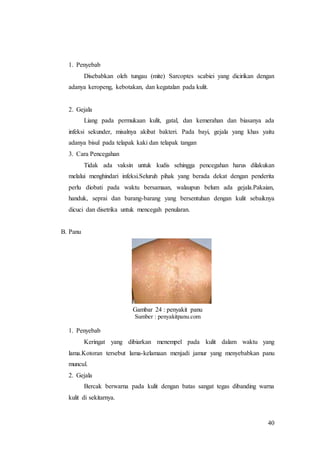 40
1. Penyebab
Disebabkan oleh tungau (mite) Sarcoptes scabiei yang dicirikan dengan
adanya keropeng, kebotakan, dan kegatalan pada kulit.
2. Gejala
Liang pada permukaan kulit, gatal, dan kemerahan dan biasanya ada
infeksi sekunder, misalnya akibat bakteri. Pada bayi, gejala yang khas yaitu
adanya bisul pada telapak kaki dan telapak tangan
3. Cara Pencegahan
Tidak ada vaksin untuk kudis sehingga pencegahan harus dilakukan
melalui menghindari infeksi.Seluruh pihak yang berada dekat dengan penderita
perlu diobati pada waktu bersamaan, walaupun belum ada gejala.Pakaian,
handuk, seprai dan barang-barang yang bersentuhan dengan kulit sebaiknya
dicuci dan disetrika untuk mencegah penularan.
B. Panu
Gambar 24 : penyakit panu
Sumber : penyakitpanu.com
1. Penyebab
Keringat yang dibiarkan menempel pada kulit dalam waktu yang
lama.Kotoran tersebut lama-kelamaan menjadi jamur yang menyebabkan panu
muncul.
2. Gejala
Bercak berwarna pada kulit dengan batas sangat tegas dibanding warna
kulit di sekitarnya.
 