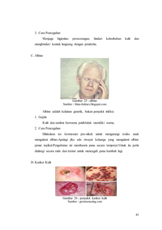 41
3. Cara Pencegahan
Menjaga higienitas perseorangan, hindari kelembaban kulit dan
menghindari kontak langsung dengan penderita.
C. Albino
Gambar 25 : albino
Sumber : thina-holmes.blogspot.com
Albino adalah kelainan genetik, bukan penyakit infeksi.
1. Gejala
Kulit dan rambut berwarna putih/tidak memiliki warna.
2. Cara Pencegahan
Dilakukan tes kromosum pra-nikah untuk mengurangi resiko anak
mengalami albino.Apalagi jika ada riwayat keluarga yang mengalami albino
jamur topikal.Pengobatan ini membasmi panu secara temporer.Untuk itu perlu
diulangi secara rutin dan teratur untuk mencegah panu kambuh lagi.
D. Kanker Kulit
Gambar 26 : penyakit kanker kulit
Sumber : grosiramazing.com
 