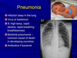 Pneumonia  <ul><li>Infection deep in the lung </li></ul><ul><li>Virus or bacterium </li></ul><ul><li>Ill, high temp, rapid...