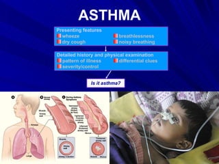 ASTHMA Thorax 2003; 58 (Suppl I): i1-i92 <ul><li>differential clues </li></ul><ul><li>pattern of illness </li></ul><ul><li...