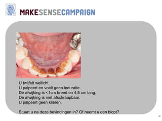 10
U twijfelt wellicht.
U palpeert en voelt geen induratie.
De afwijking is <1cm breed en 4,5 cm lang.
De afwijking is niet afschraapbaar.
U palpeert geen klieren.
Stuurt u na deze bevindingen in? Of neemt u een biopt?
 