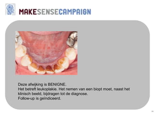 11
Deze afwijking is BENIGNE.
Het betreft leukoplakie. Het nemen van een biopt moet, naast het
klinisch beeld, bijdragen tot de diagnose.
Follow-up is geïndiceerd.
 