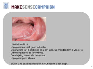 13
U twijfelt wellicht.
U palpeert en voelt geen induratie.
De afwijking is 1,5cm breed en 3 cm lang. De mondbodem is vrij, er is
uitbreiding tot op de farynxboog.
De afwijking is niet afschraapbaar.
U palpeert geen klieren.
Stuurt u na deze bevindingen in? Of neemt u een biopt?
 