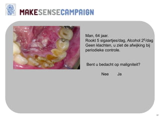 17
Man, 64 jaar.
Rookt 5 sigaartjes/dag, Alcohol 2E/dag
Geen klachten, u ziet de afwijking bij
periodieke controle.
Bent u bedacht op maligniteit?
Nee Ja
 
