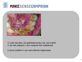 18
U voelt induratie. De gebitselementen zijn niet mobiel.
In de hals palpeert u een vergrote klier ipsilateraal.
U stuurt patiënt in voor aanvullende diagnostiek.
 
