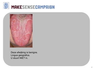 2
Deze afwijking is benigne.
Lingua geografica.
U stuurt NIET in.
 