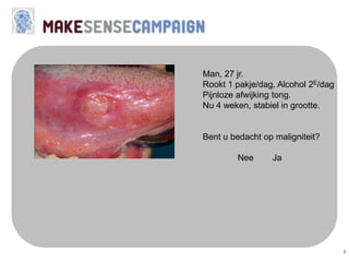 3
Man, 27 jr.
Rookt 1 pakje/dag, Alcohol 2E/dag
Pijnloze afwijking tong.
Nu 4 weken, stabiel in grootte.
Bent u bedacht op maligniteit?
Nee Ja
 