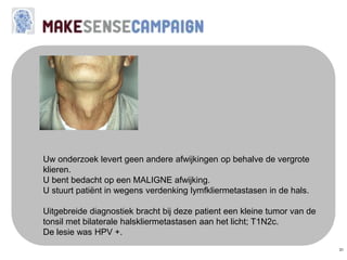 31
Uw onderzoek levert geen andere afwijkingen op behalve de vergrote
klieren.
U bent bedacht op een MALIGNE afwijking.
U stuurt patiënt in wegens verdenking lymfkliermetastasen in de hals.
Uitgebreide diagnostiek bracht bij deze patient een kleine tumor van de
tonsil met bilaterale halskliermetastasen aan het licht; T1N2c.
De lesie was HPV +.
 