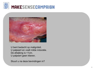 4
U bent bedacht op maligniteit.
U palpeert en voelt milde induratie.
De afwijking is <1cm.
U palpeert geen klieren.
Stuurt u na deze bevindingen in?
 
