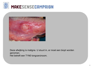 5
Deze afwijking is maligne. U stuurt in, er moet een biopt worden
genomen.
Het betreft een T1N0 tongcarcinoom.
 