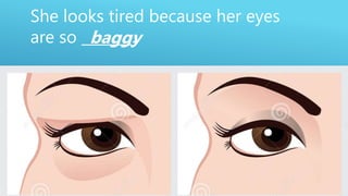 She looks tired because her eyes
are so _______.baggy
 