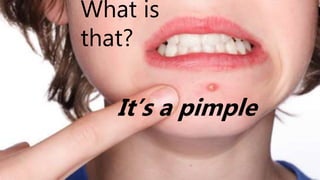 What is
that?
It’s a pimple
 