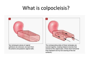 Making a case for colpocleisis.ppt