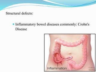 Structural defects:
 Inflammatory bowel diseases commonly: Crohn's
Disease
 