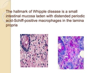 The hallmark of Whipple disease is a small
intestinal mucosa laden with distended periodic
acid-Schiff-positive macrophages in the lamina
propria
.
 