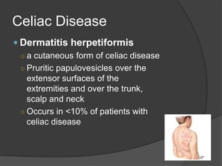 Celiac DiseaseDermatitis herpetiformisa cutaneous form of celiac diseasePruriticpapulovesicles over the extensor surfaces of the extremities and over the trunk, scalp and neckOccurs in <10% of patients with celiac disease