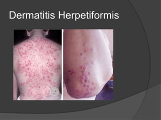 Dermatitis Herpetiformis