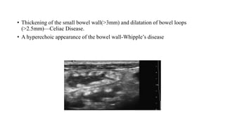 • Thickening of the small bowel wall(>3mm) and dilatation of bowel loops
(>2.5mm)—Celiac Disease.
• A hyperechoic appearance of the bowel wall-Whipple’s disease
 