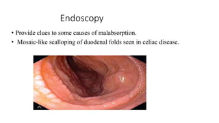 Endoscopy
• Provide clues to some causes of malabsorption.
• Mosaic-like scalloping of duodenal folds seen in celiac disease.
 