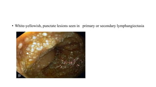 • White-yellowish, punctate lesions seen in primary or secondary lymphangiectasia
 