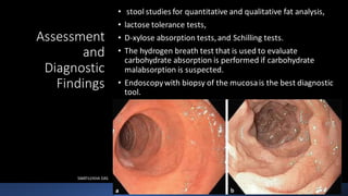 Assessment
and
Diagnostic
Findings
• stool studies for quantitative and qualitative fat analysis,
• lactose tolerance tests,
• D-xylose absorption tests,and Schilling tests.
• The hydrogen breath test that is used to evaluate
carbohydrate absorption is performed if carbohydrate
malabsorption is suspected.
• Endoscopywith biopsy of the mucosais the best diagnostic
tool.
SWATILEKHA DAS
4
 